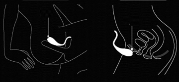 Nalone CoCo Paarvibrator Partnervibrator Couples Vibrator - 3